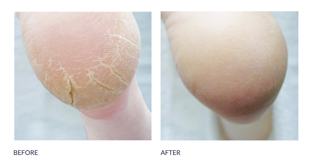 Footlogix Formule contre les gerçures et les crevasses 3+ - Dealorys